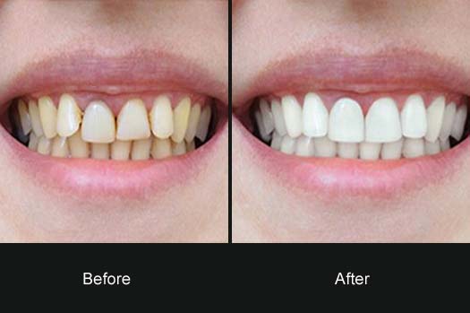 Cosmetic Dentistry / Smile Makeover